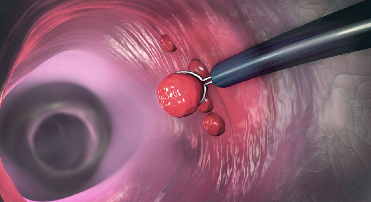 Polypectomy Procedure