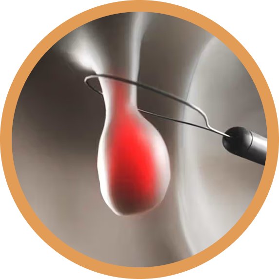 Acidity and Reflux