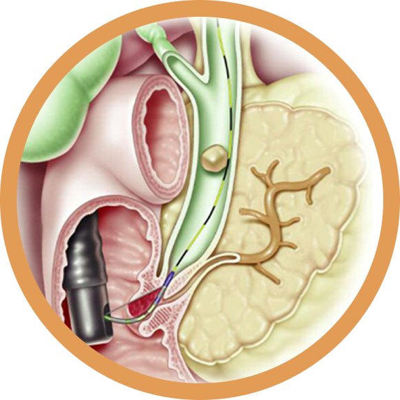 ERCP