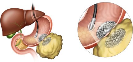 EUS Guided Pseudocyst Drainage
