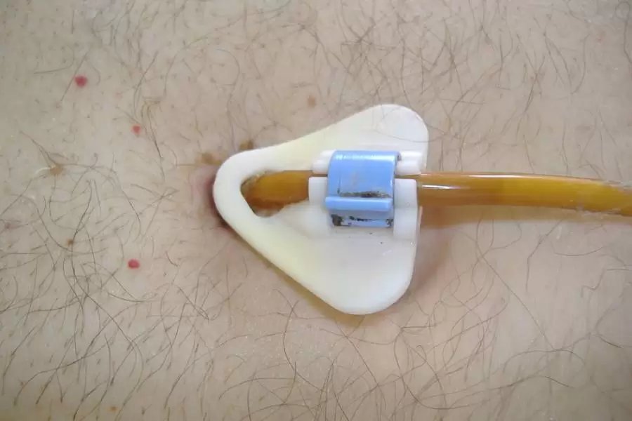 PEG Tube Placement