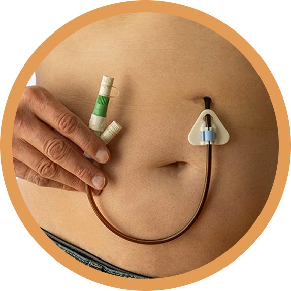 PEG Tube Placement