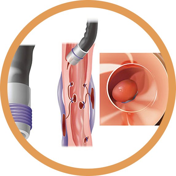 Acidity and Reflux