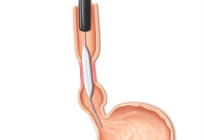 Stricture Dilatation