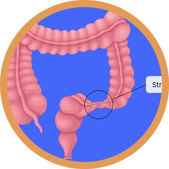 Acidity and Reflux